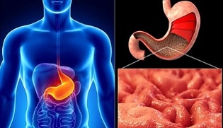 The rules of nutrition for gastritis