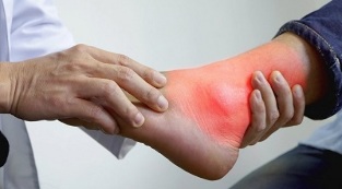 What to eat and what not to do with gout in the legs